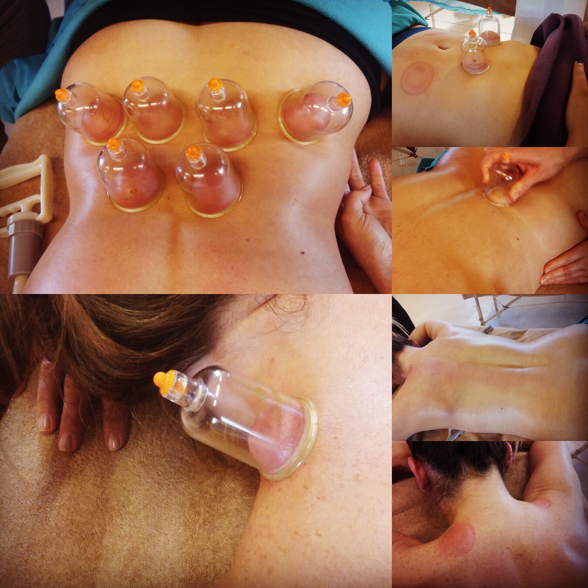 Cupping Therapy-Coppettazione
